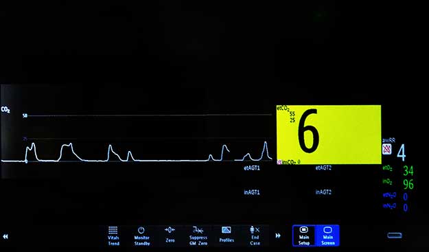 Bad CO2 readings with a nasal cannula